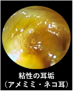 粘性の耳垢